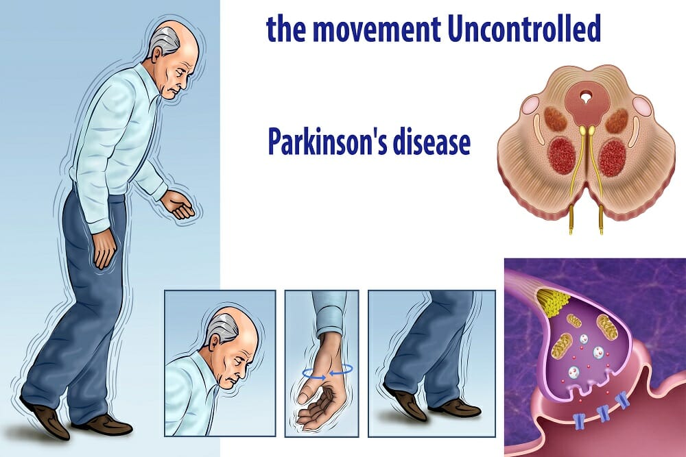 Are sleep issues a factor on Parkinson's