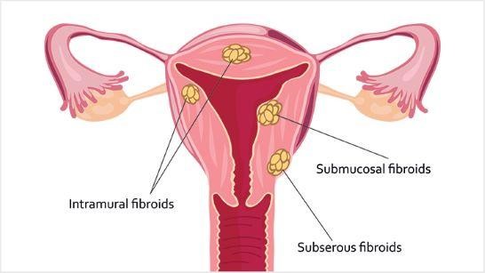 How to treat uterine cancer