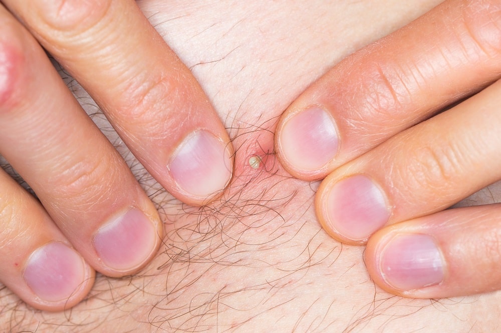 Hands,Of,A,Caucasian,Man,Squeezing,Pimple,Due,To,Ingrown