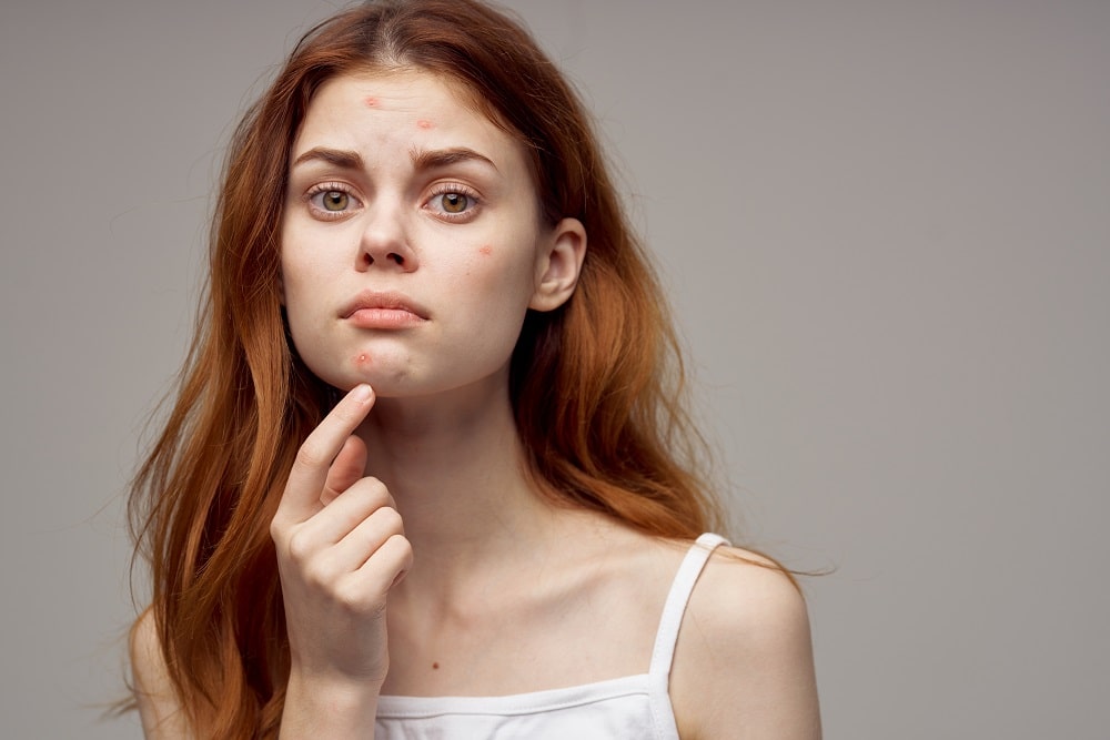 Redheaded,Woman,Shows,Fingers,On,Acne,On,Her,Face