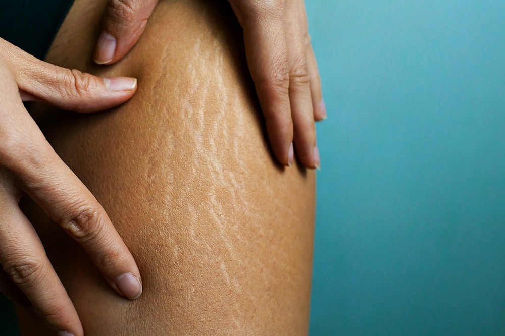 Treating and Preventing Stretch Marks