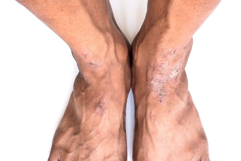 Ankle,Of,The,Old,Man,With,Chronic,Scars,Or,Foot