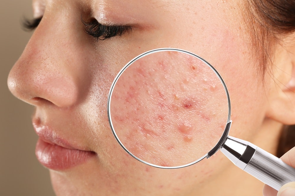 Teenage,Girl,With,Acne,Problem,Visiting,Dermatologist,,Closeup.,Skin,Under