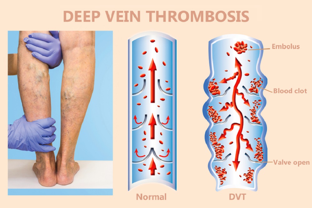 Deep Vein Thrombosis Awareness Month: Signs your vein issue may be more than just cosmetic